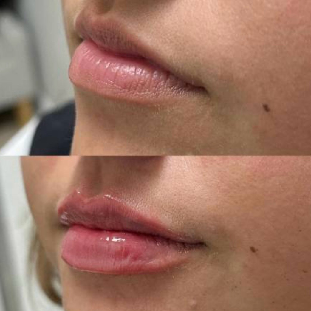 Antes y después — aumento de labios