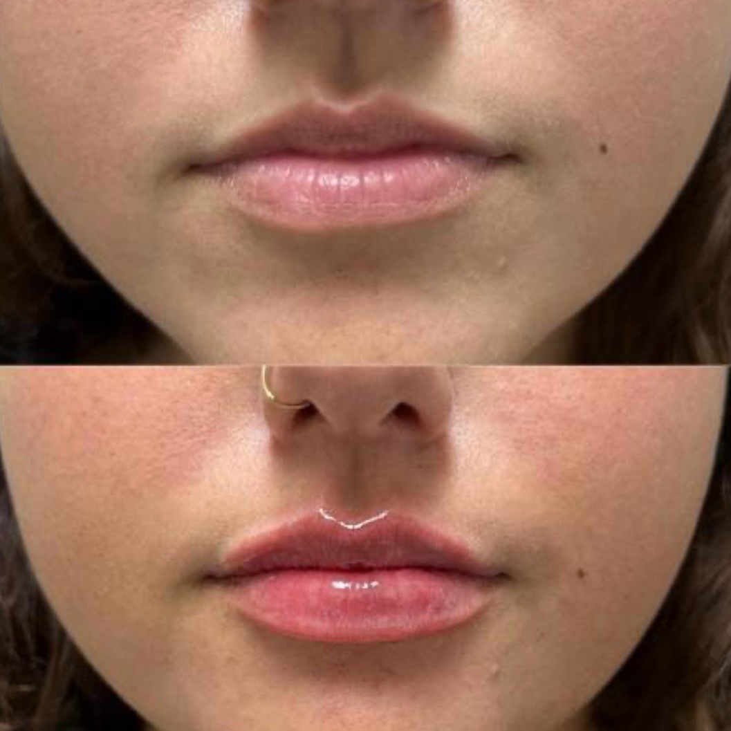 Antes y después — aumento de labios