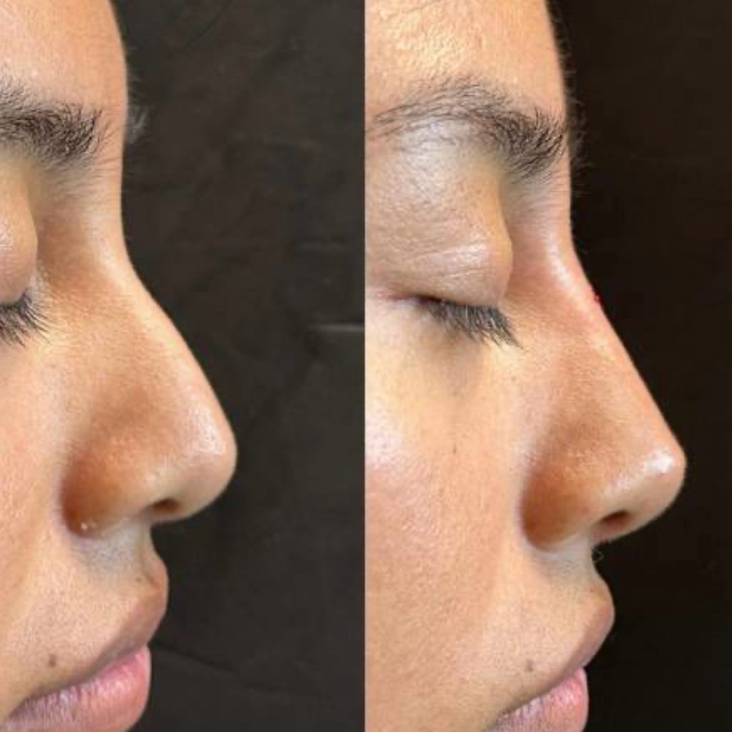 Antes y después — rinomodelación