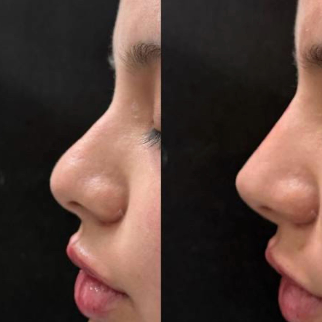 Antes y después — rinomodelación