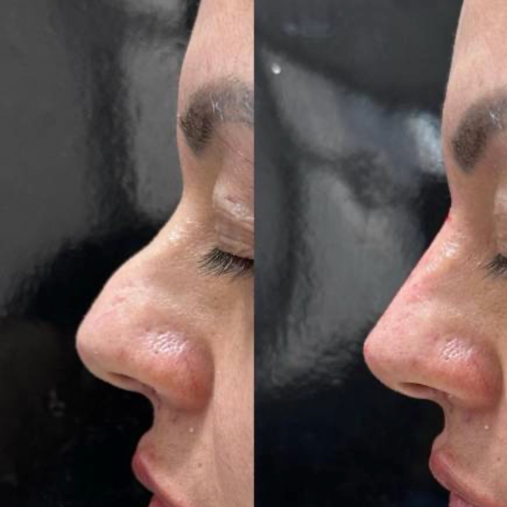 Antes y después — rinomodelación