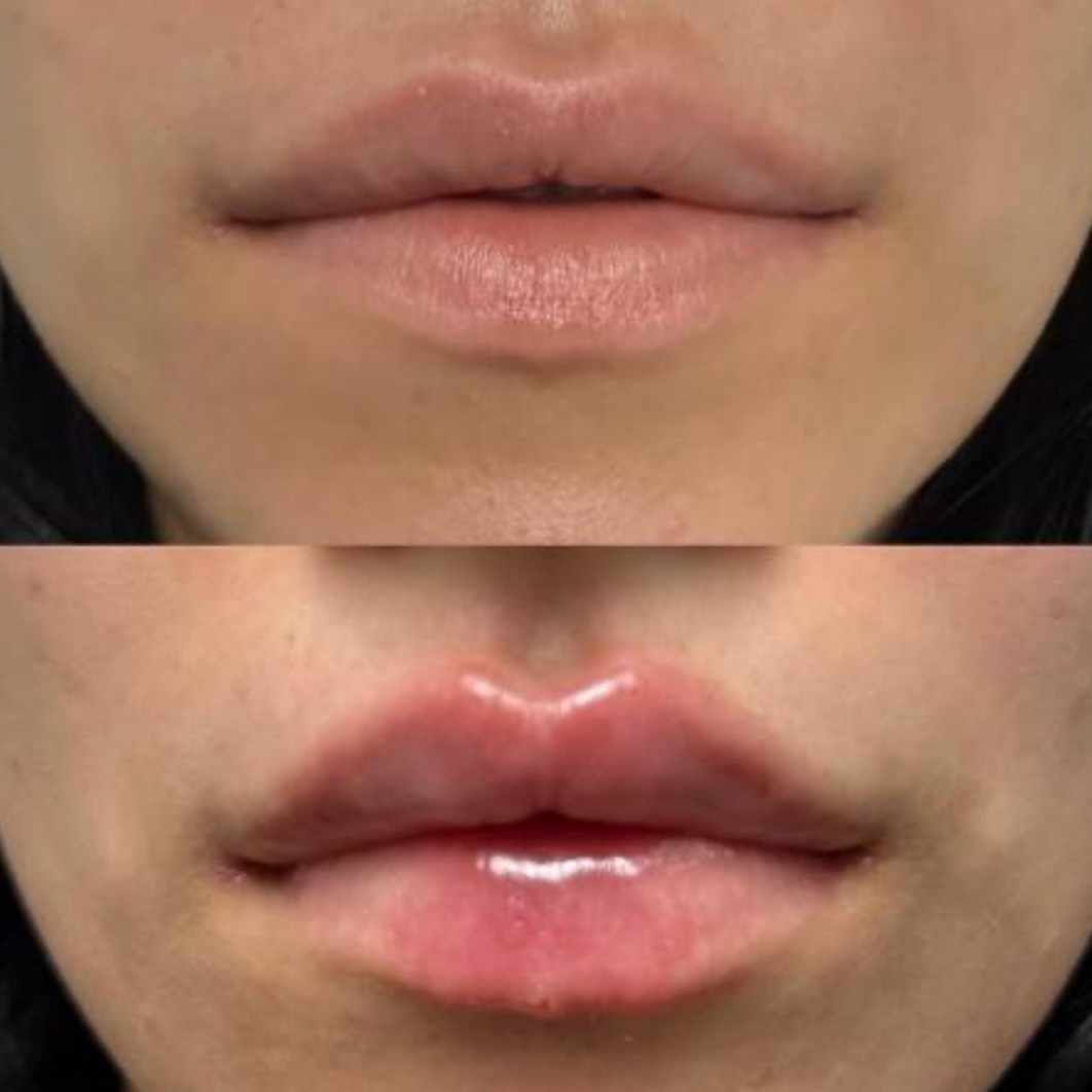 Antes y después — aumento de labios