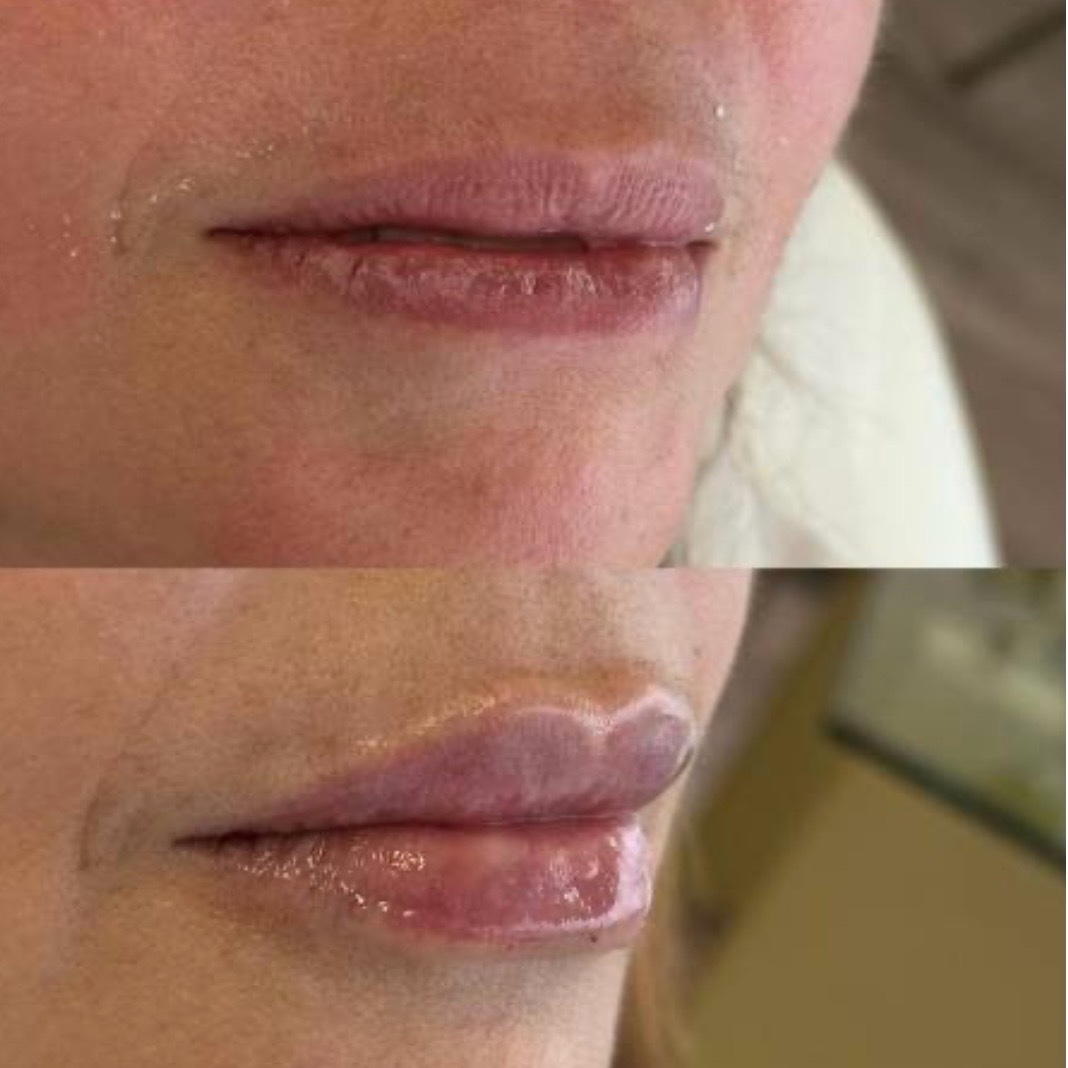 Antes y después — aumento de labios