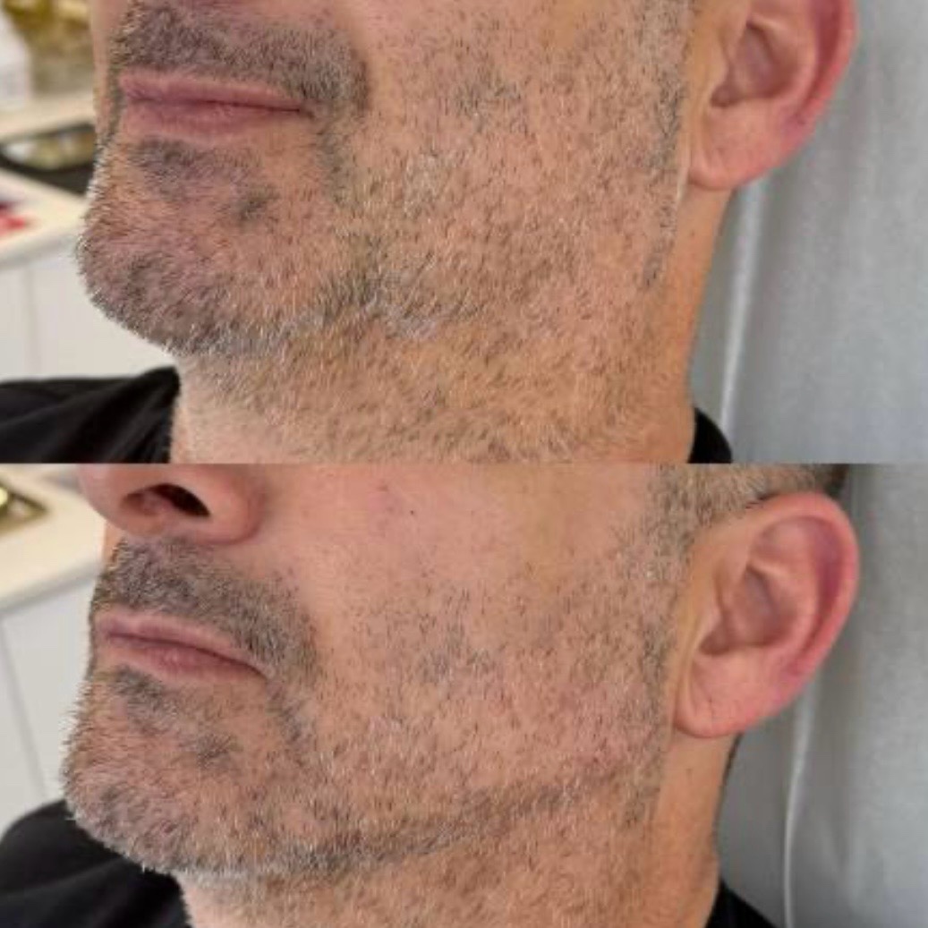 Antes y después — contorno facial