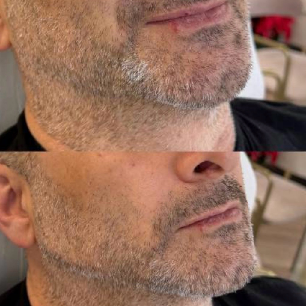 Antes y después — definición de mandíbula