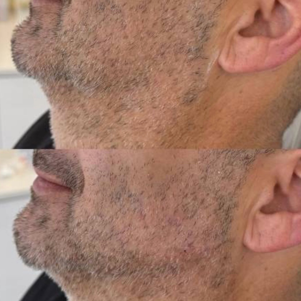 Antes y después — contorno facial