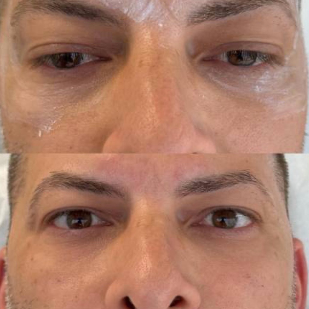 Antes y después — rejuvenecimiento de ojeras