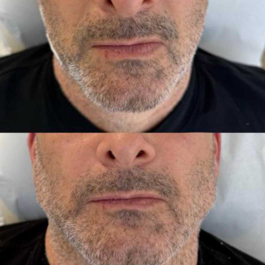 Antes y después — definición mandibular