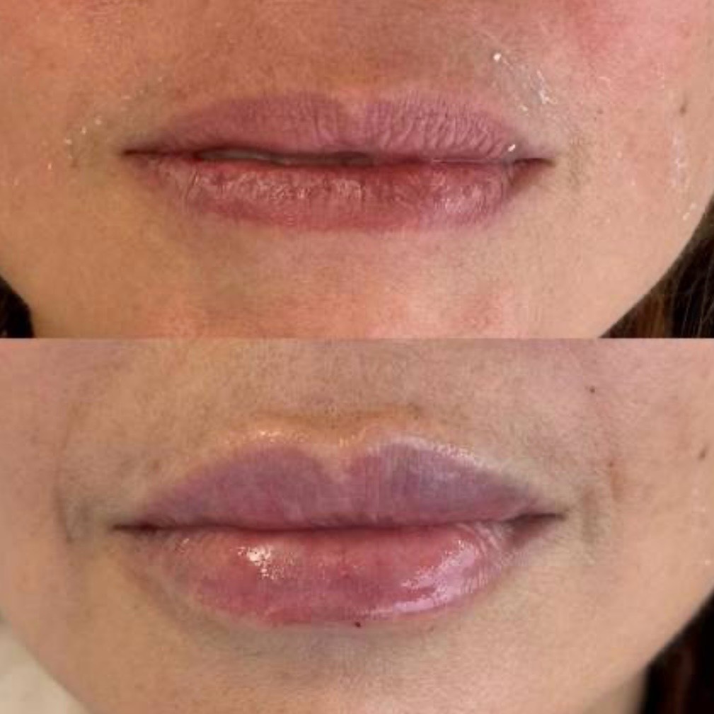 Antes y después — aumento de labios