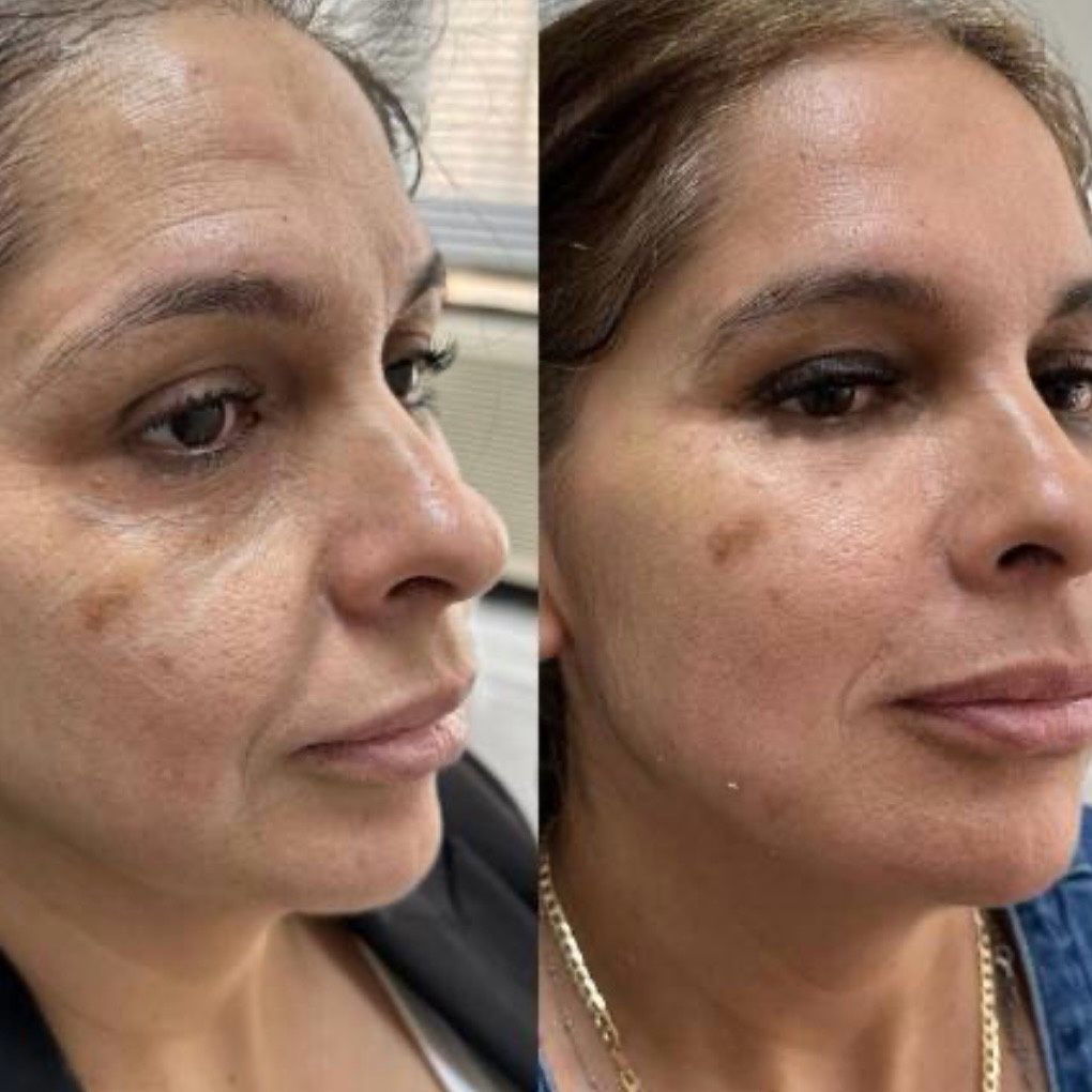 Antes y después — armonización facial y manchas