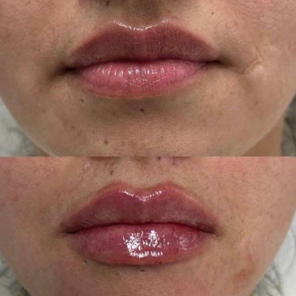 Antes y después — aumento de labios